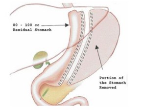 胃袖状切除手术(缩胃手术)减重
